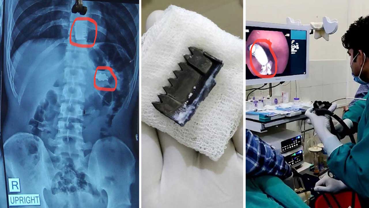 नोबेलमा बिरामीको पेटबाट निकालियो पेटीको ‘बक्कल’ र सिक्री